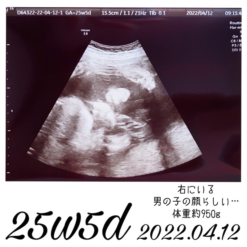 妊娠25週エコー写真1
