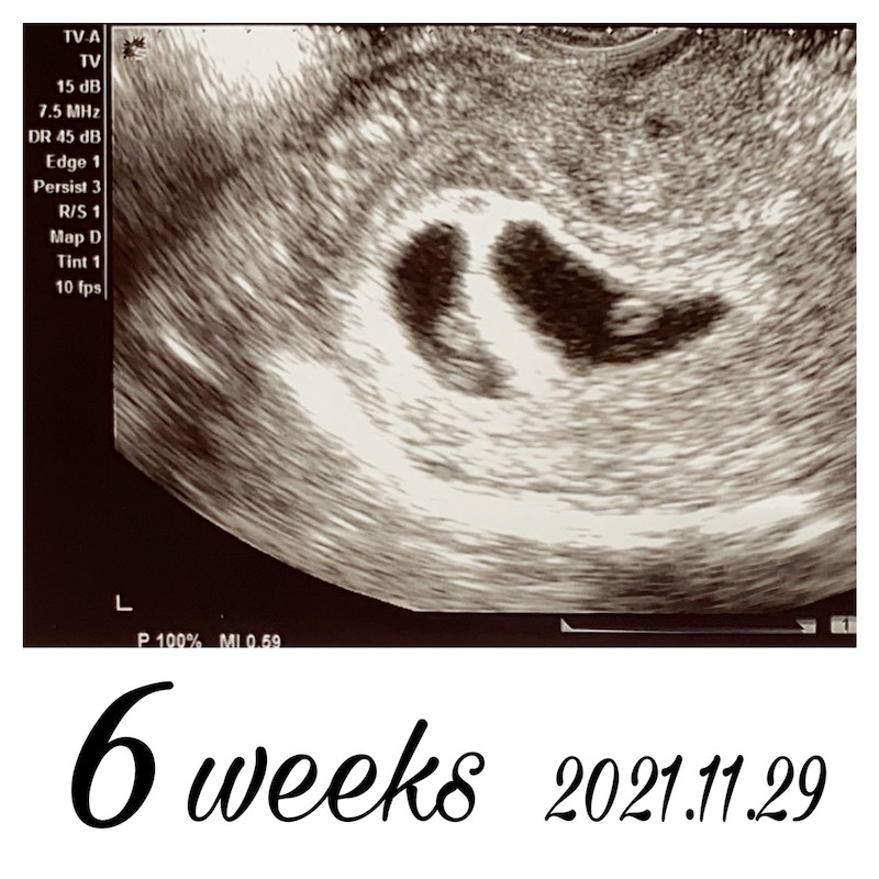 胎嚢確認妊娠6週目