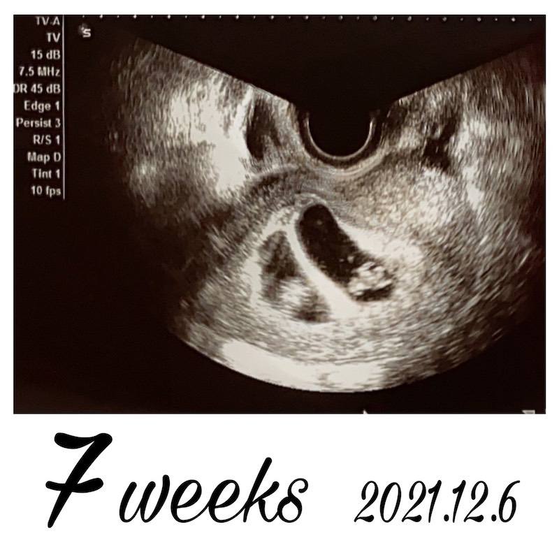 胎嚢確認妊娠7週目